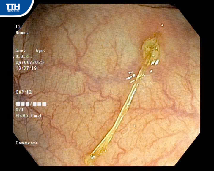 PHÁT HIỆN XƯƠNG CÁ SẮC NHỌN TRONG ĐƯỜNG TIÊU HOÁ NHỜ NỘI SOI KỊP THỜI